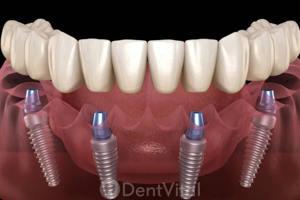 All-on-4 / All-on-6 implant sistemleri