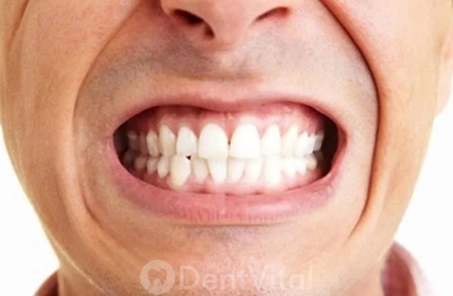 Bruksizm (Diş Sıkma) Tedavisi