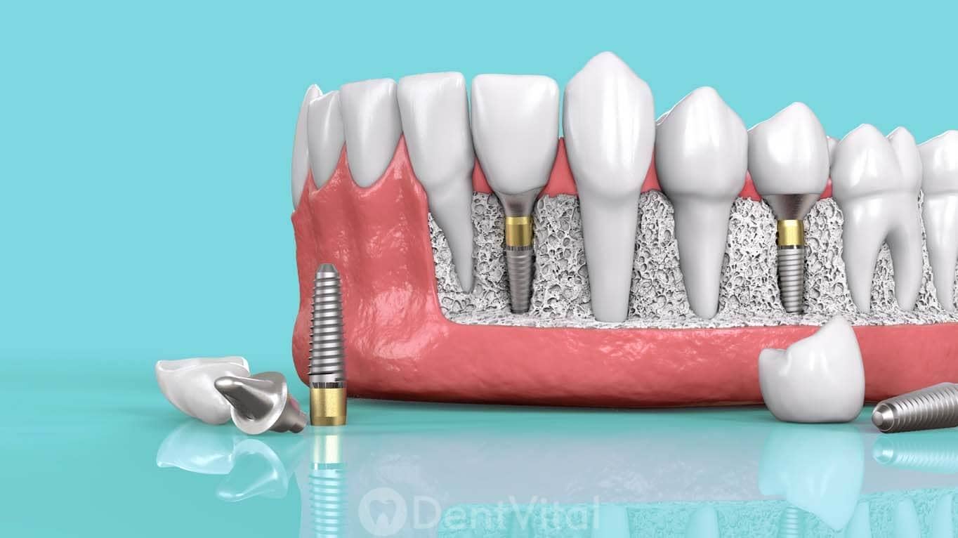 Çoklu diş implantı