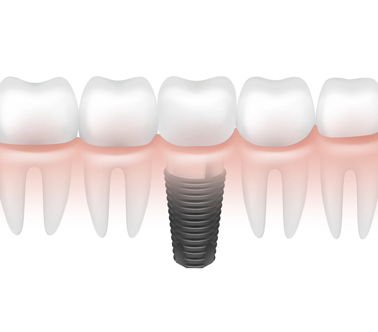 Diş implantı nedir, nasıl yapılır, implant fiyatları