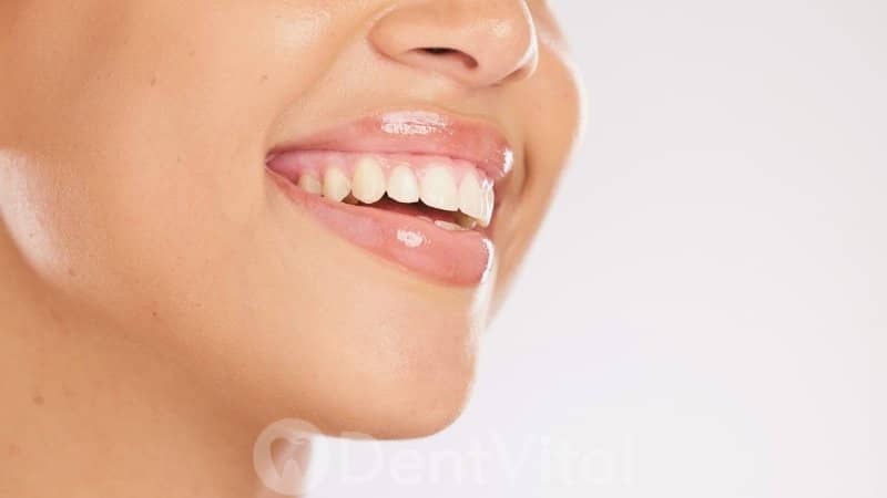 Gummy smile tedavisi
