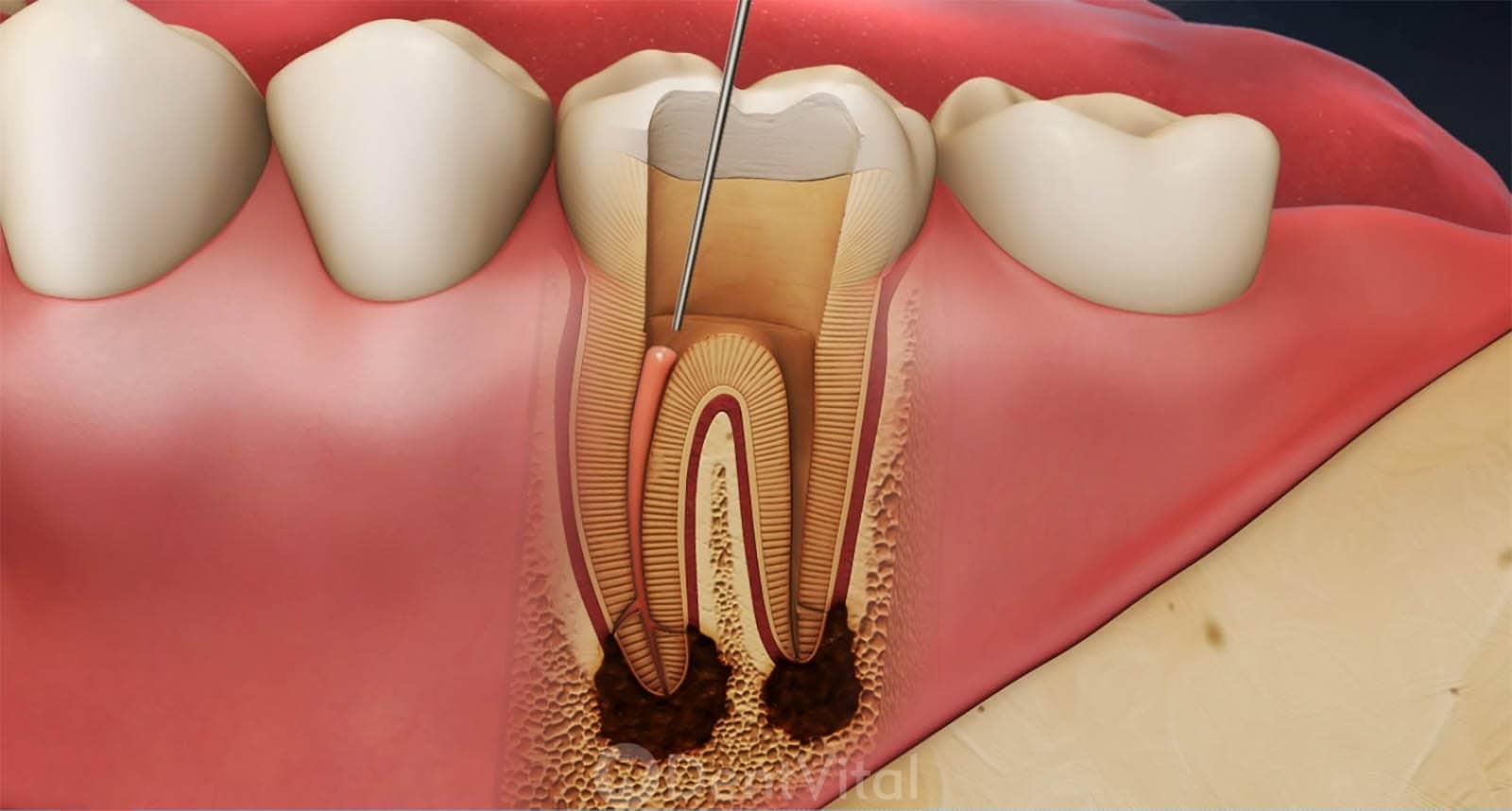 Kanal Tedavisi (Endodonti)