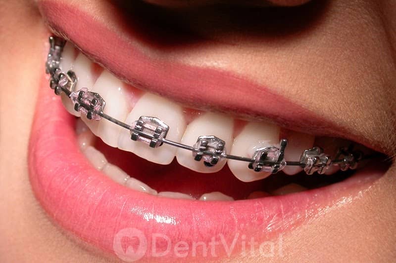 Metal braketler