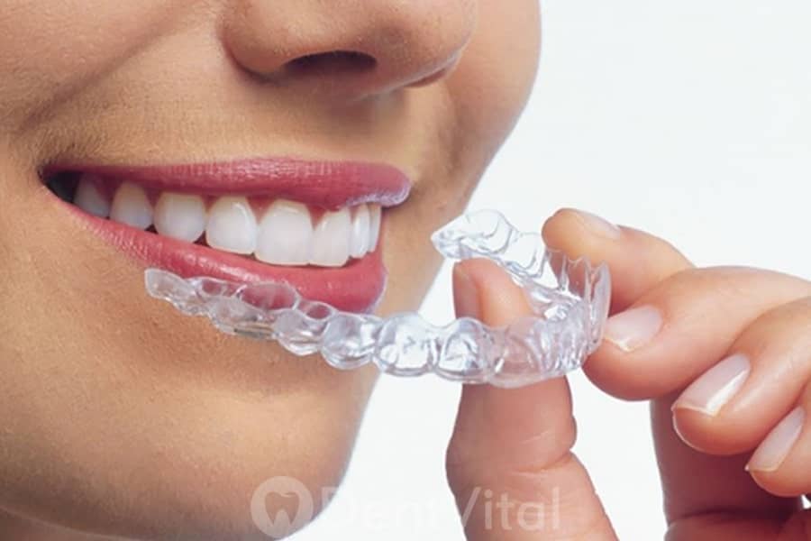 Şeffaf Plaklar (Invisalign)