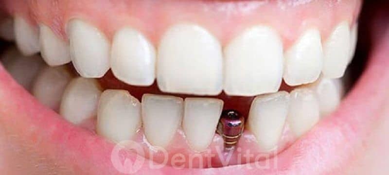 Tek diş implantı