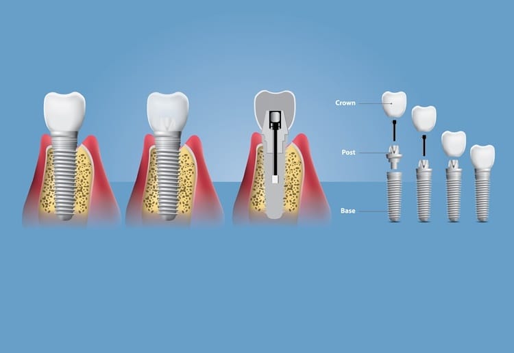 İmplant Tedavisinde Doğru Hekimi Seçmenin Önemi