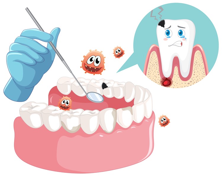 Agresif Periodontitis Nedir?