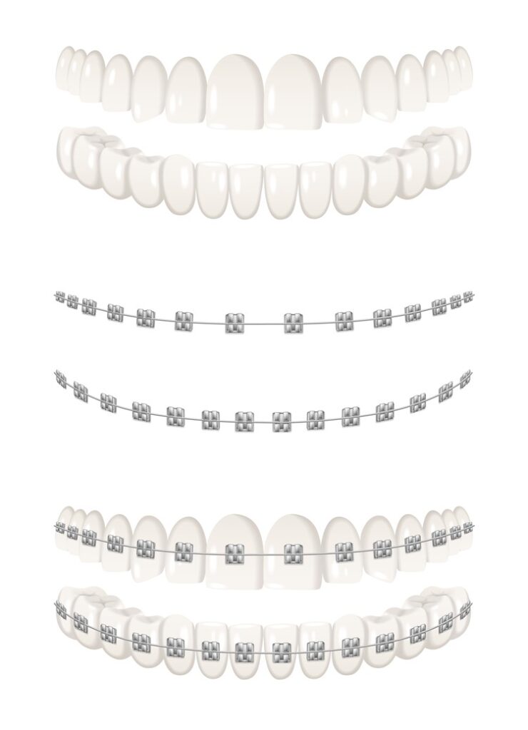 Braket Nedir? 1 Braket Çeşitleri Nelerdir?