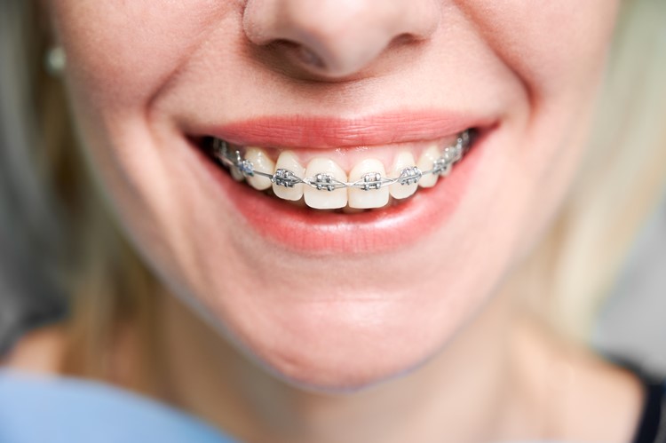 Braket Nedir?