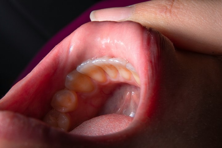 Diş Eti Hastalıkları Nasıl Önlenir?