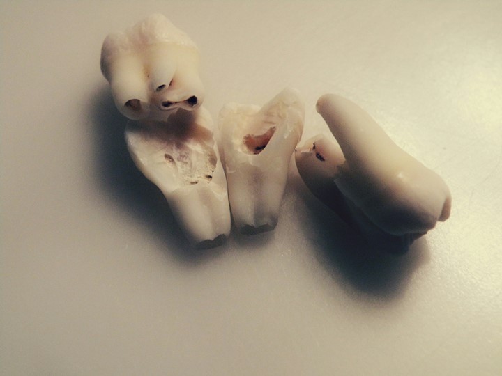 Dişin Çürümesiyle Kök Nasıl ve Ne Zaman Kaybolur?