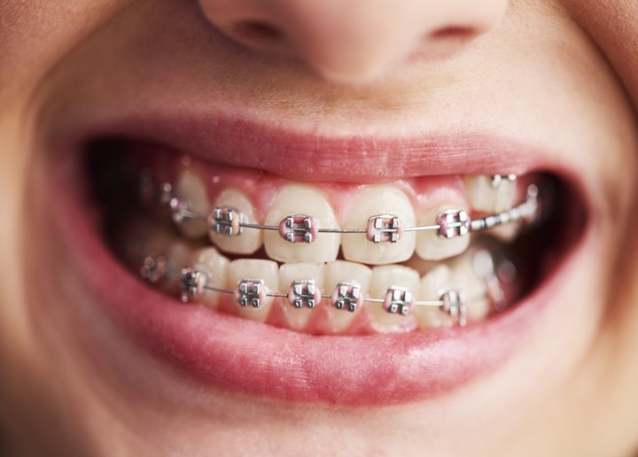 Invisalign ve Geleneksel Diş Telleri Karşılaştırması 1 Geleneksel Diş Teli Tedavisi Nedir?