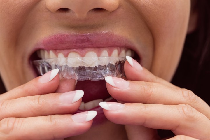 Invisalign Nedir?