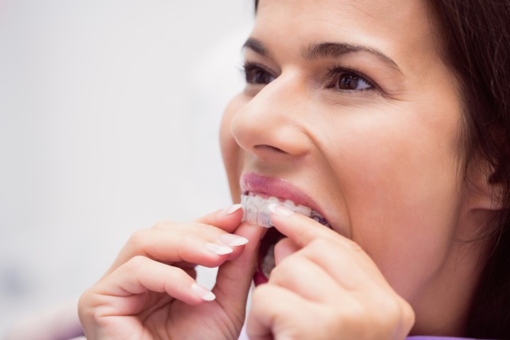 Invisalign Tedavisi Nasıl Uygulanır?
