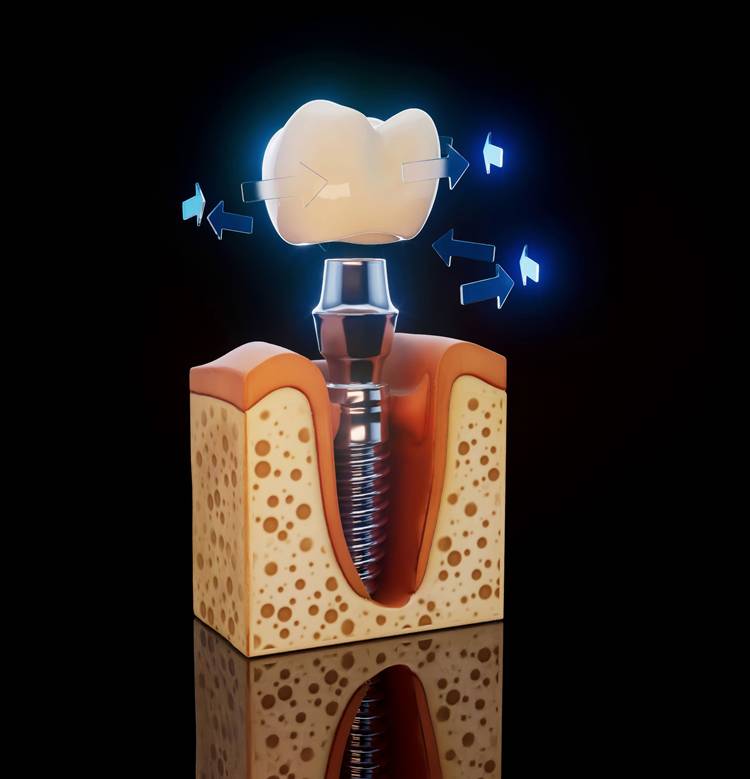 Hastaların En Çok Sorduğu Soru: Fiber Post İmplant Yerine Geçer mi?