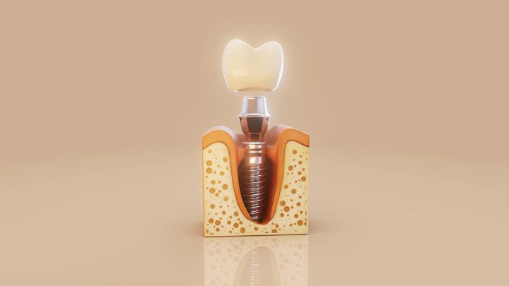 İmplant Ömrü Ne Kadar? İmplant Düşerse Ne Yapılır? Yerli İmplantlar Kısa Ömürlü mü?