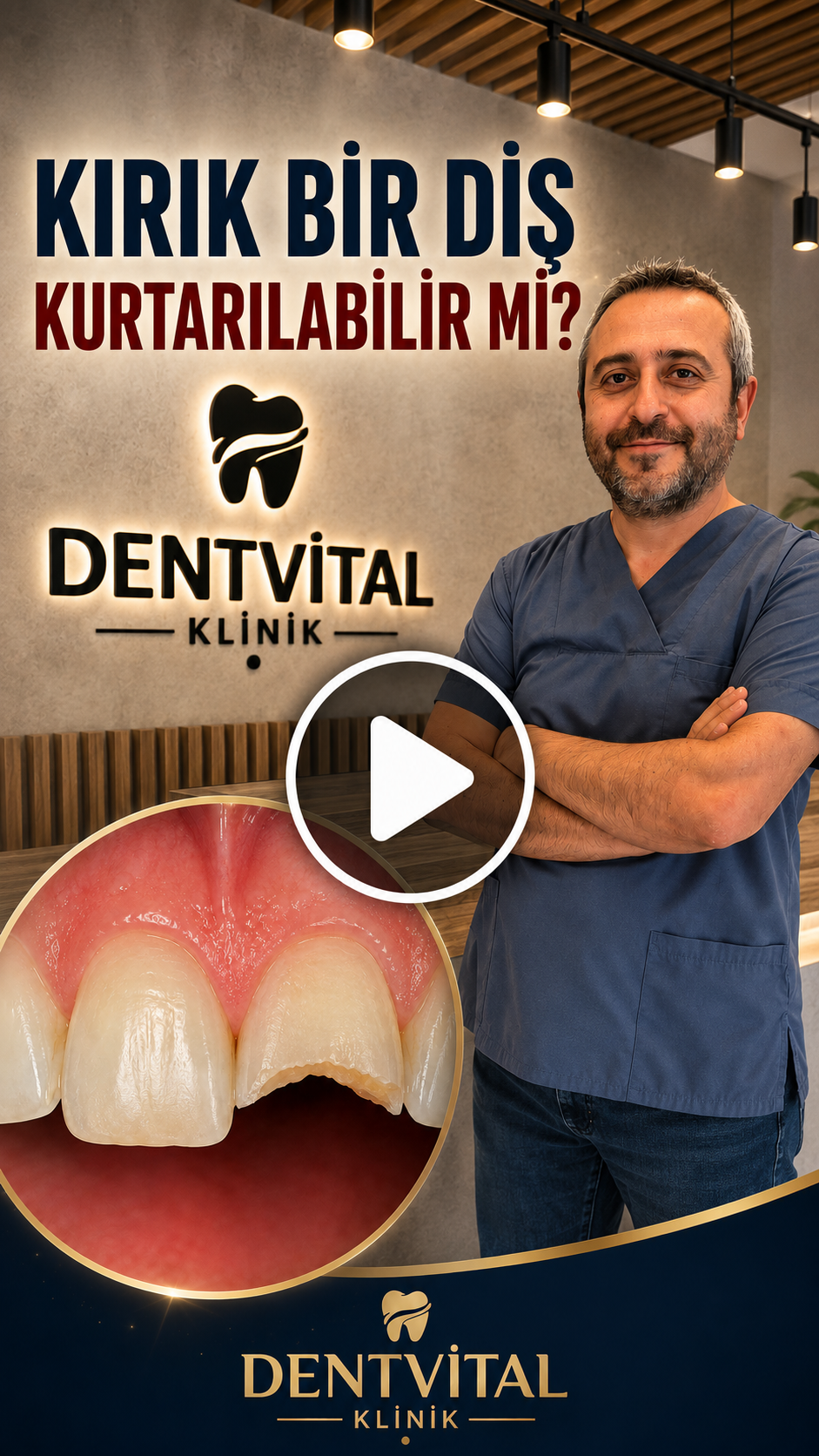 DentVital 28 kırık diş kurtarılır mı - fiber post nedir