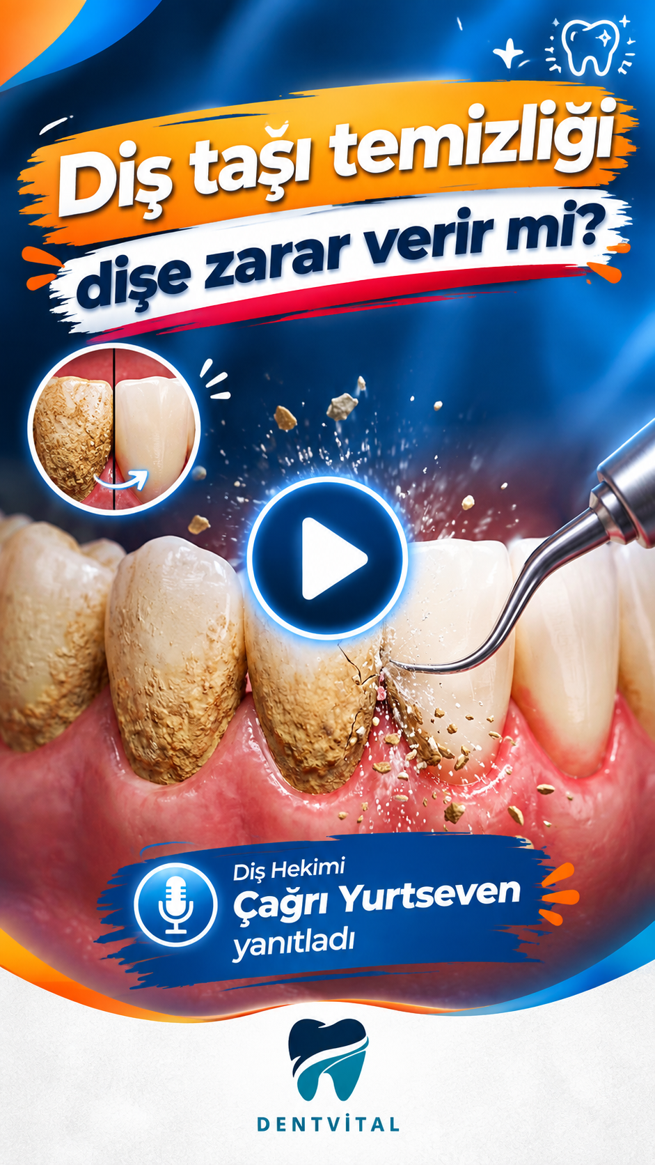 DentVital 25 Diş taşı temizliği dişe zarar verir mi? #diştaşı#dentist