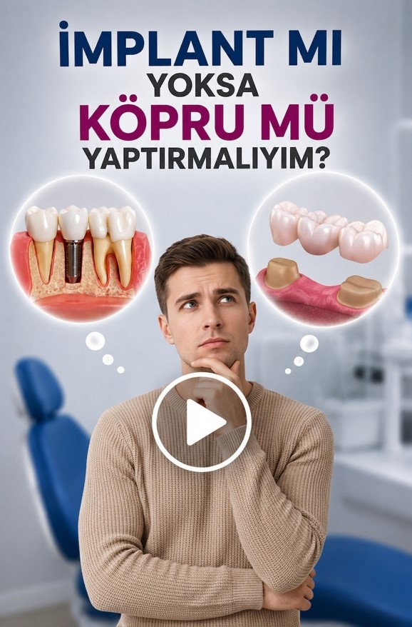 DentVital 25 İmplant mı yoksa köprü/kaplama mı yaptırmalıyım? #implant #dentist