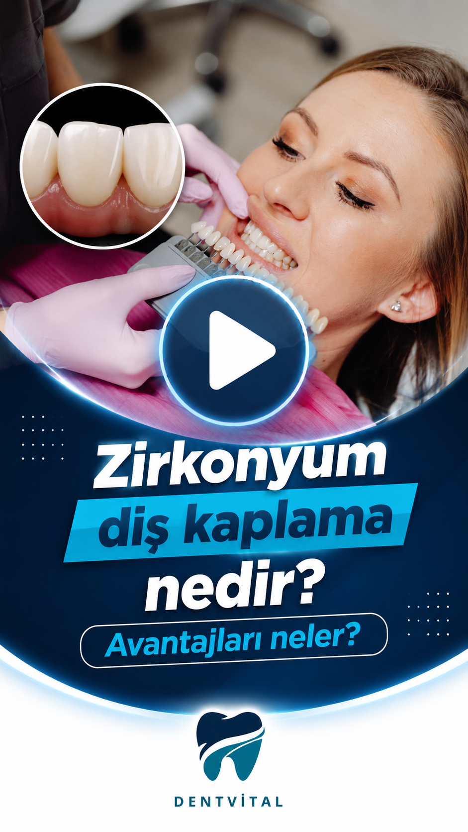 DentVital 26 Zirkonyum diş kaplama nedir? Avantajları nelerdir?